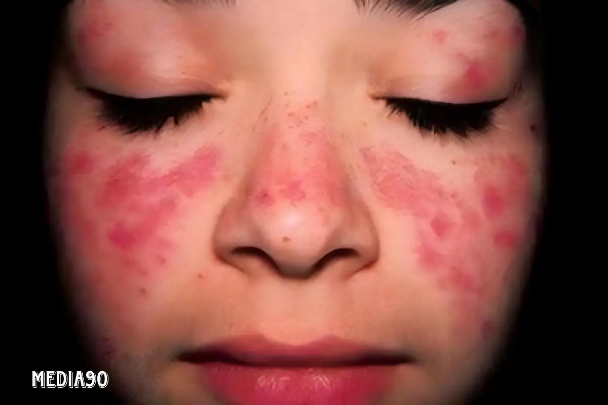 10 Gejala Awal Lupus yang Perlu Diwaspadai dan Cara Mencegahnya