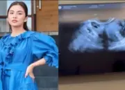 Chelsea Olivia Tegaskan Tak Hamil Anak Ketiga, Kunjungan ke Dokter Kandungan untuk Pap Smear Rutin