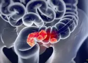 Lonjakan Kanker Usus Usia Muda, Studi Temukan Jejak Herbisida dalam DNA